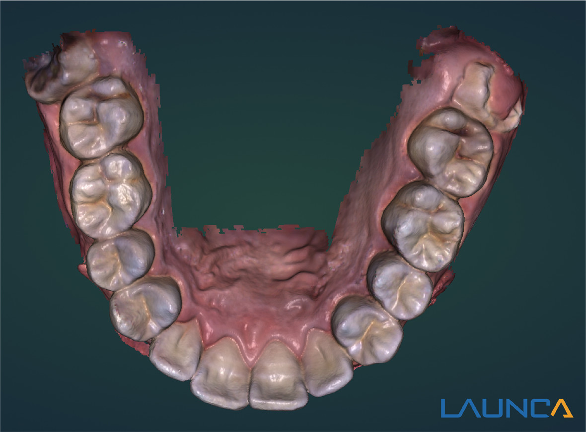 Launca Dgital Impression Data