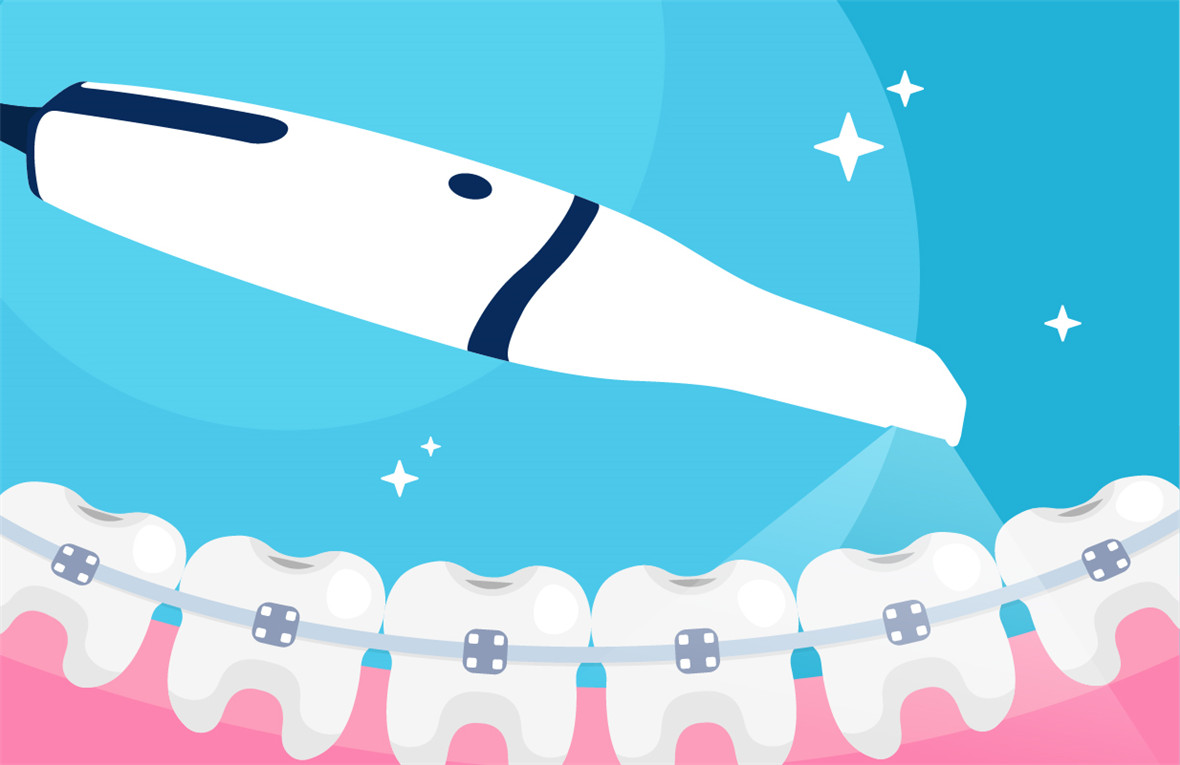 How Intraoral Scanners Help the Orthodontic Treatment