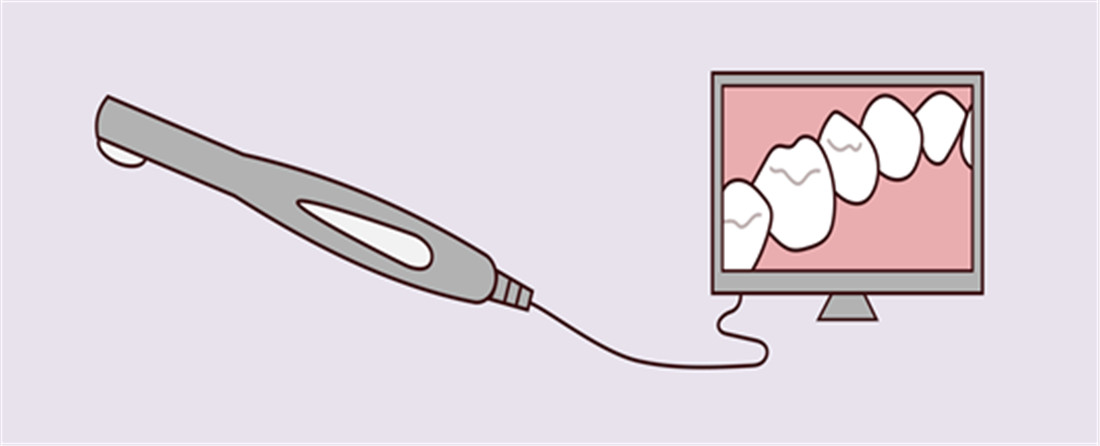 What is an Intraoral Scanner and How Does it Work1