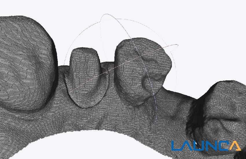 launca dl206 구강내 스캐너로 매시 이미지 스캔